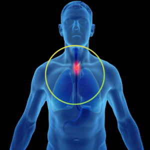 image of throat cancer
