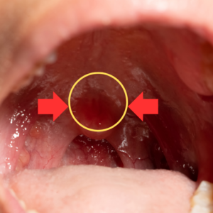 tonsillitis