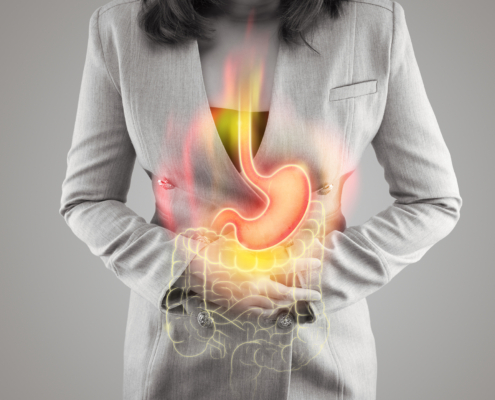 An image of a woman with a graphical image of an inflamed stomach and esophagus on the front of her symbolizing acid reflux.