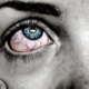 A close-up image of a person's bloodshot eyes signifying an allergic reaction.
