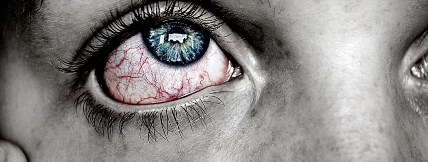 A close-up image of a person's bloodshot eyes signifying an allergic reaction.