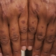 A close-up image of hands reveals visible sun spots, also known as age spots or solar lentigines, on darker skin tones, highlighting the effects of sun exposure and skin pigmentation changes. The natural lighting accentuates the appearance of dark patches, suggesting the need for sun protection and effective skincare routines to manage skin discoloration.